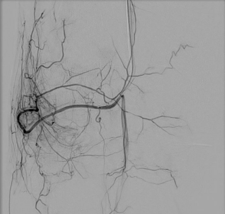 rechtes Kniegelenk - vor Behandlung