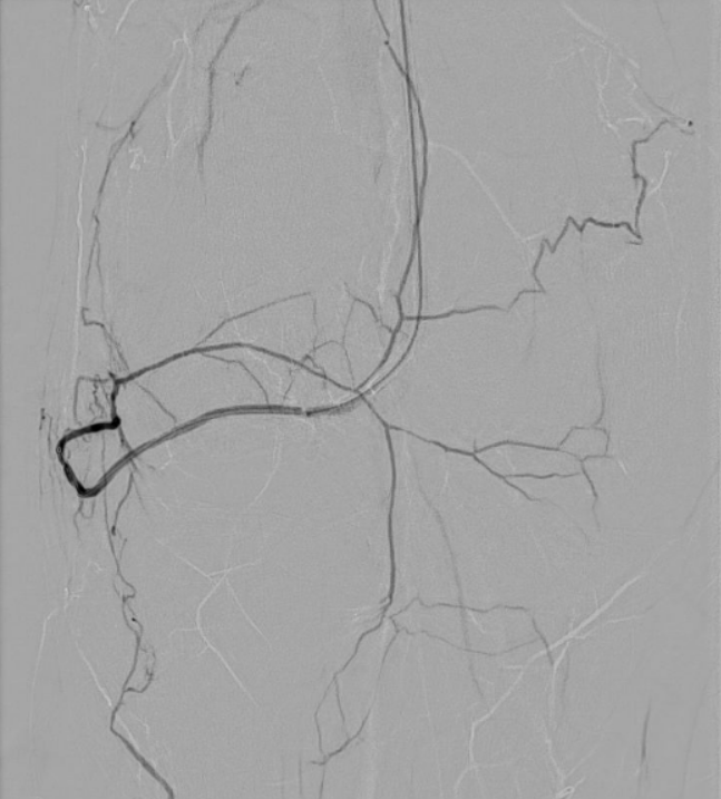 rechtes Kniegelenk - nach Behandlung